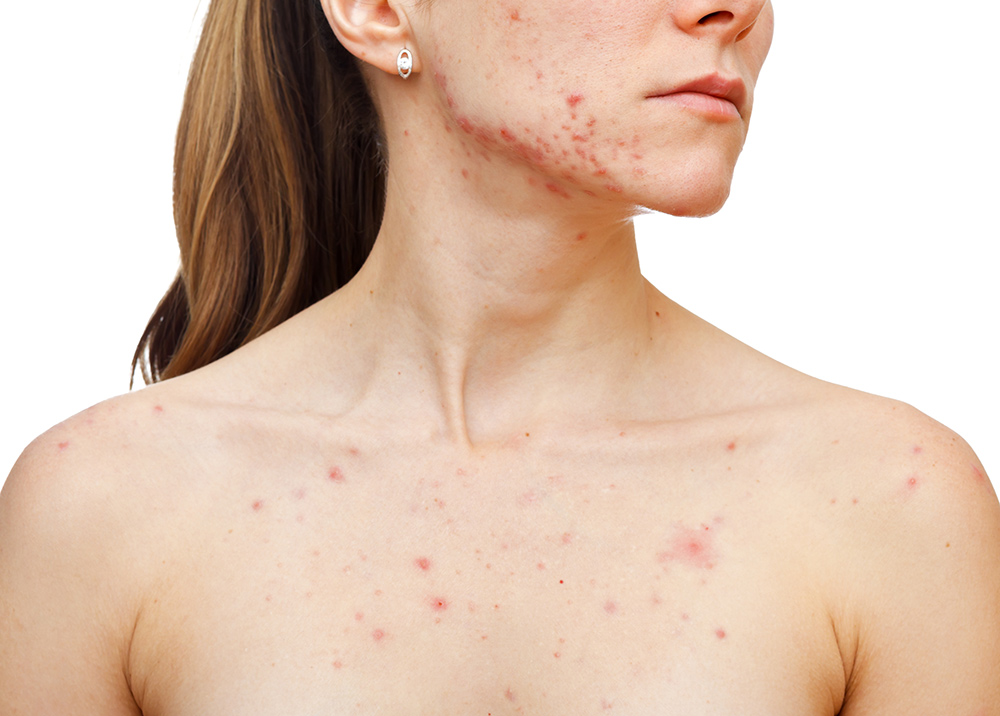 Cách trị mụn và phòng tránh mụn xuất hiện trở lại tại 5 vùng da trên cơ thể