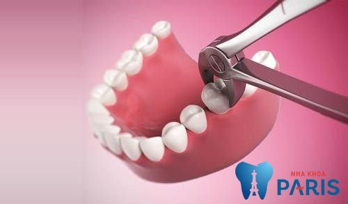 Nhổ răng có ảnh hưởng gì đến sức khỏe không?
