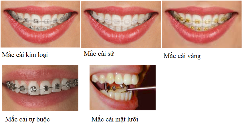 Niềng răng là gì và các loại niềng răng bạn nên biết