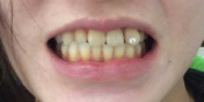 Chia sẻ từ các chuyên gia: Răng sứ có tẩy trắng được không?