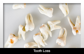 Mất răng có thể là hậu họa cho sức khỏe