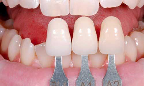 Bọc răng sứ có đau không và những điều cần biết