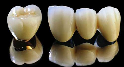 Bất ngờ khi biết bọc răng sứ Titan giá bao nhiêu?