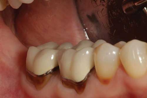 Nguyên nhân và cách khắc phục bọc răng sứ bị hở chân răng