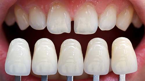 Bọc răng sứ được bao nhiêu năm? Chuyên gia tư vấn