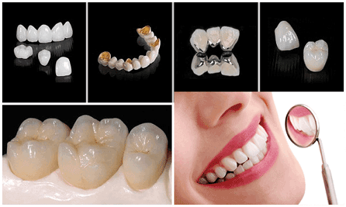 Nguyên nhân và cách phòng tránh bọc răng sứ gây hôi miệng