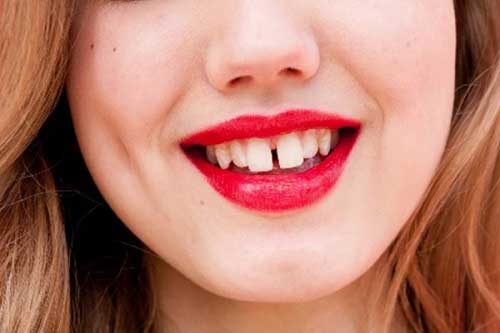 Giải đáp băn khoăn về việc bọc răng sứ lợi và hại ra sao