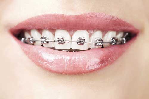 Nên bọc răng sứ hay niềng răng thẩm mỹ thì tốt hơn?