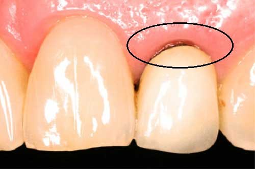Nguyên nhân và giải pháp khắc phục bọc răng sứ bị đen nướu