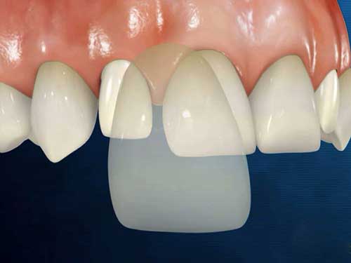 Có nên bọc răng sứ thẩm mỹ không? Bác sĩ tư vấn