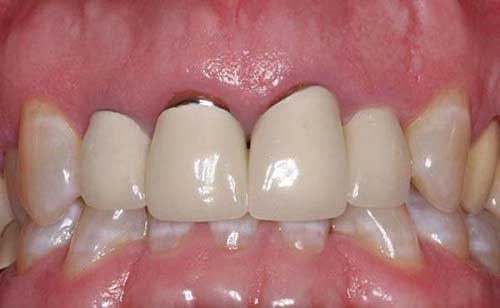 Bọc răng sứ bị hở lợi thì phải làm sao để khắc phục?