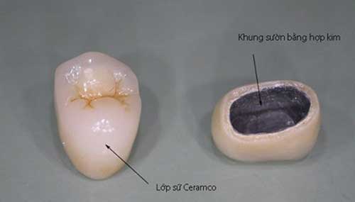 Chuyên gia tư vấn bọc răng sứ Ceramco 3 có bền không?
