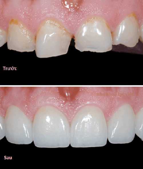 Khám phá ưu điểm và nhược điểm của bọc răng sứ cho răng thưa