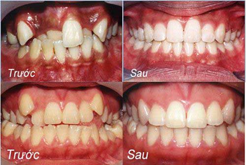 Khám phá quá trình bọc răng sứ cho răng khấp khểnh