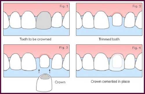 Bọc răng sứ hàm dưới cho răng sâu vỡ mẻ được không?
