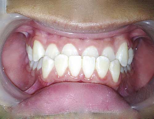Chi phí bọc răng sứ hàm trên bao nhiêu tiền?