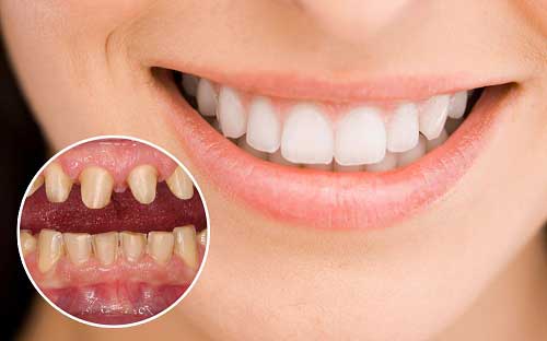 Bật mí cách khắc phục hôi miệng khi bọc răng sứ
