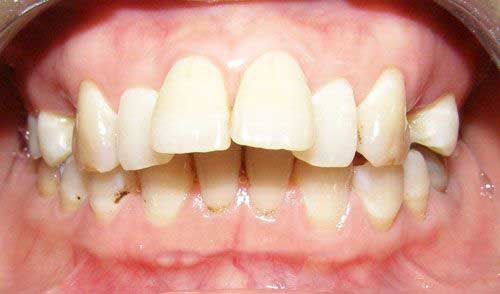 Răng hô nên niềng hay bọc răng sứ thì tốt hơn?