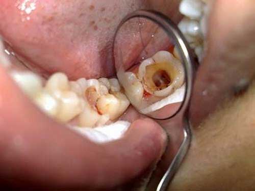 Nguyên nhân và cách khắc phục sau khi bọc sứ răng bị ê buốt