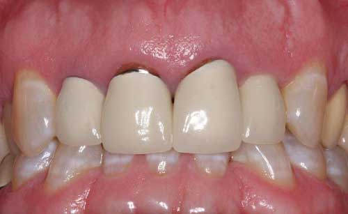 Tìm hiểu tác dụng phụ khi bọc răng sứ kim loại hiện nay