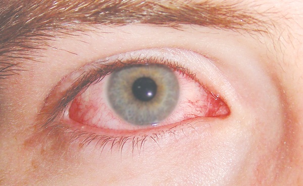 Thuốc chữa trị rối loạn cương cứng gây nên mờ mắt