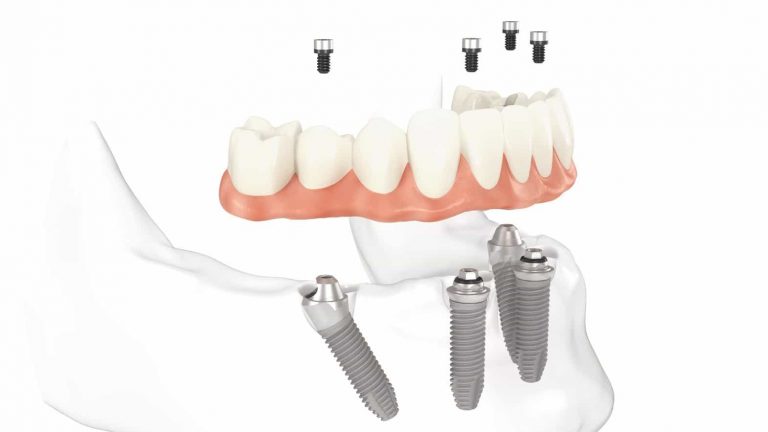 Thực hiện trồng răng hàm ở nha khoa nào uy tín biên hòa